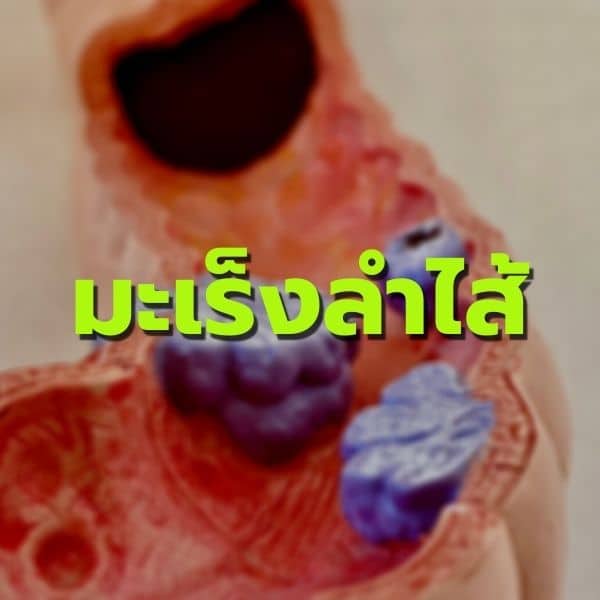 เจาะลึกพอลลิติน มะเร็งลำไส้