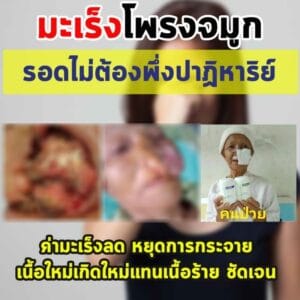 พอลลิตินมะเร็งโพรงจมูก1