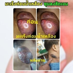 พอลลิตินมะเร็งต่อมน้ำเหลือง2