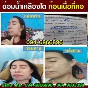 ต่อมน้ำเหลืองโตที่คอ