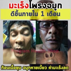พอลลิตินมะเร็งโพรงจมูก2